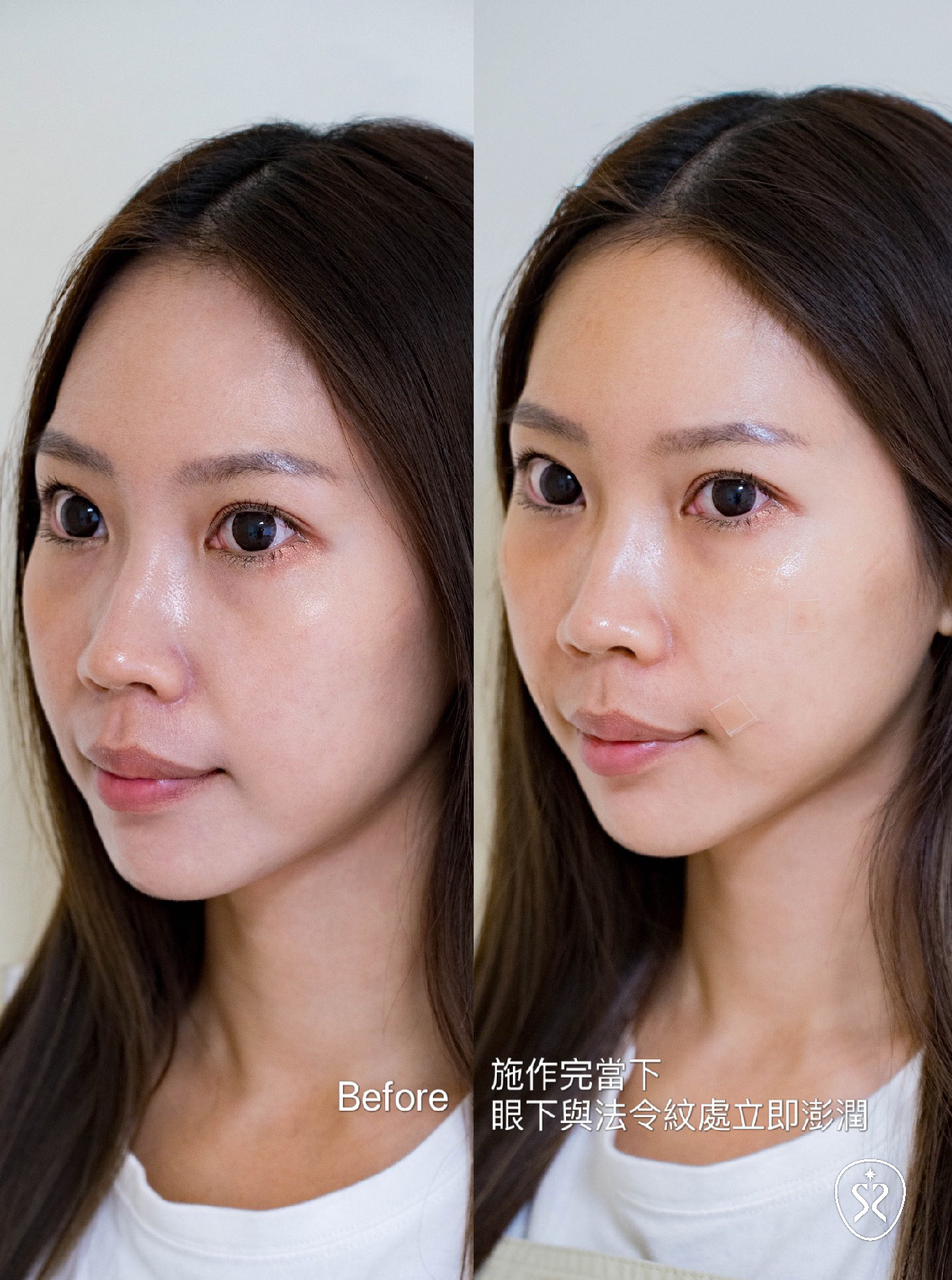 台中星和診所-薇貝拉施作後臉頰澎潤自然